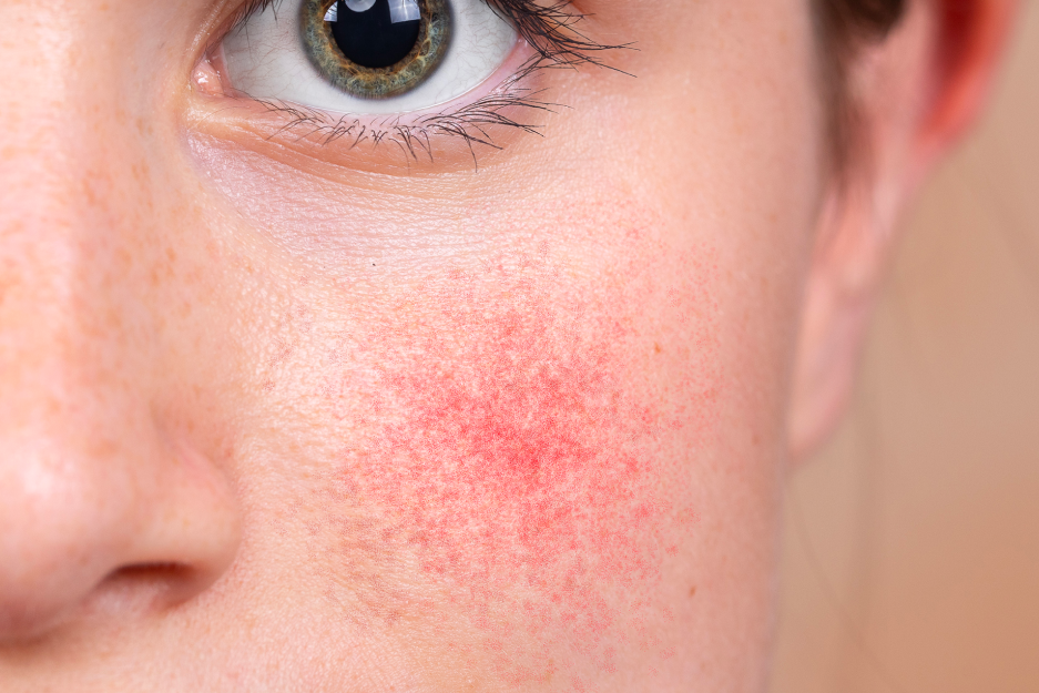 white woman with green eyes rosacea on cheeks