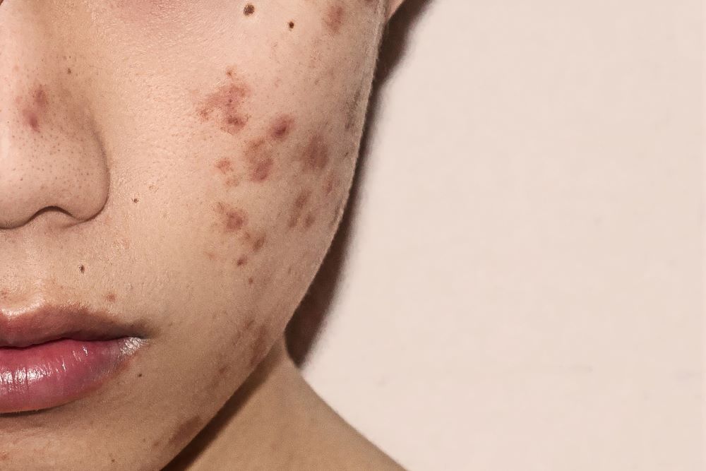 acne scarring