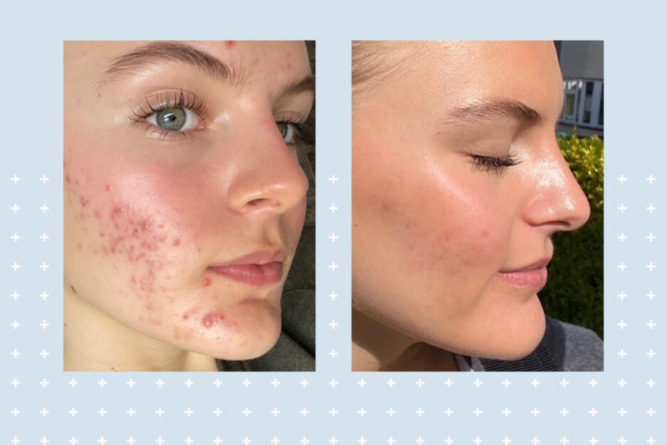 before and after skin + me skin and me acne treatment evie