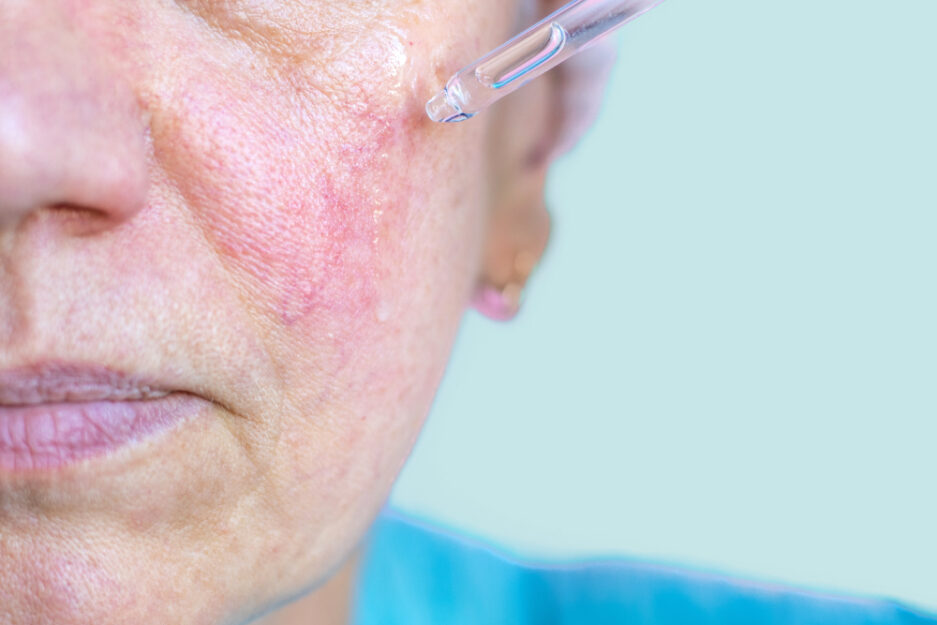 ask a dermatologist: how to treat rosacea