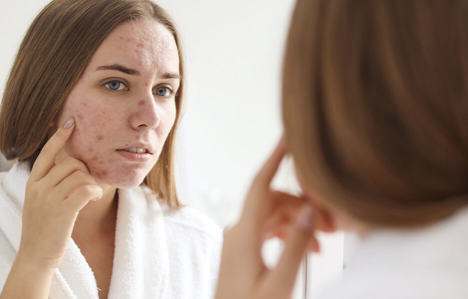 women checking her skin for acne or roascea